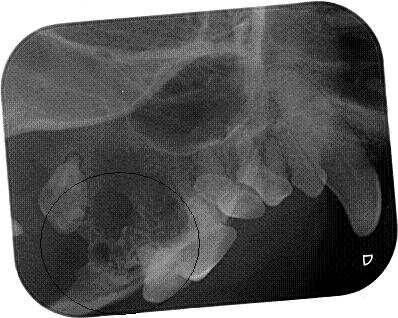 Radiograph Following Tooth Removal