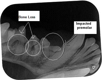 Radiograph Showing Bone Loss and Impacted Premolar