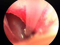 Ear Canal After Removing Material and Irrigating Ear